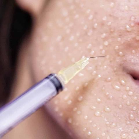 Yüz Mezoterapisi: Cildinizi Gençleştirin ve Yenileyin